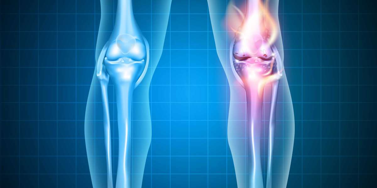 Osteoarthritis Therapy Market Technology, Development, Trends and Opportunities Market Research Report to 2030