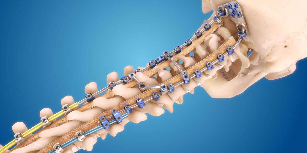 Spinal Implants Market Key Highlights and Future Opportunities till 2031